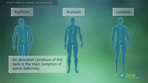 Spinal Deformities. Symptoms - YouTube