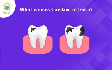 tooth caries causes Archives - Elite Dental Care