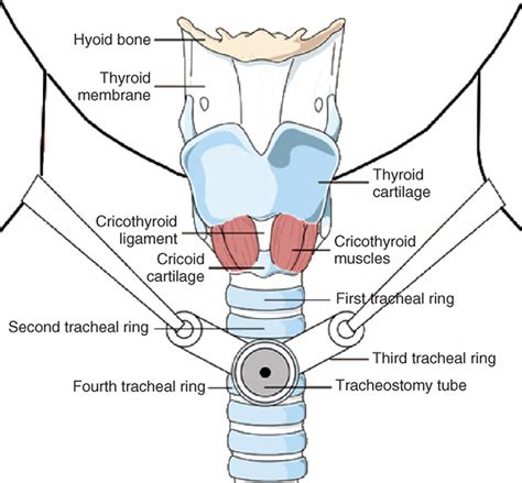 Tracheostomy - Procedure, Care, Tracheostomy Complications