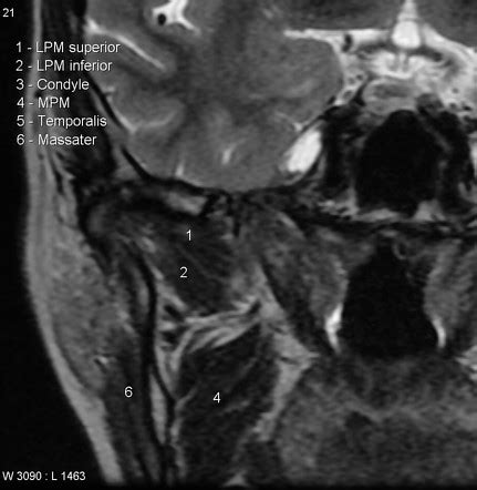 Pterygoid Plate Radiograph