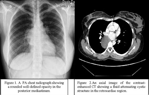 Esophageal Duplication Cyst: An unusual cause of Acute Chest Pain ...