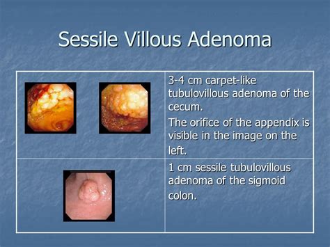 Sessile Colon Polyp