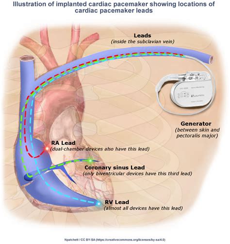 Types of Pacemakers used to treat Bradycardia or Slow Heart Rate