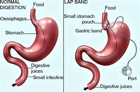 What is Lap Band Surgery & its Side Effects? | Better Weigh Center