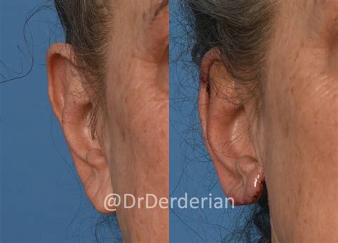 Reduction Otoplasty — Dr Derderian — Plastic and Reconstructive Surgery