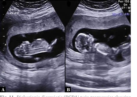 Figure 11 from Acrania-exencephaly-anencephaly sequence phenotypic ...