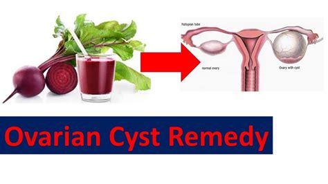 How To Get Rid Of Ovarian Cysts At Home With Natural Remedy[Fast Cure ...