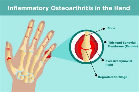 Understanding Erosive Osteoarthritis: Causes, Symptoms, Treatment