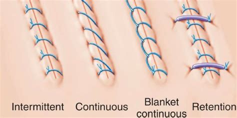 Surgical Suture Commonly Use Materials:Size and Techniques - RNpedia