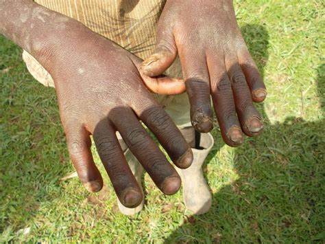 Eradicate jiggers in 3 districts in Kenya - GlobalGiving