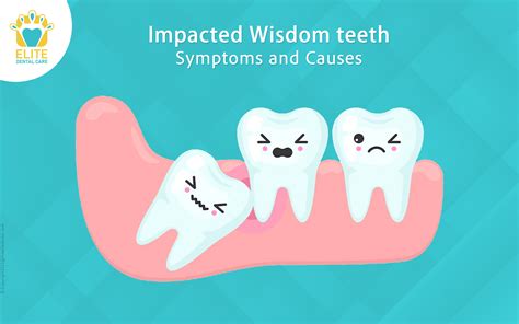 Impacted Wisdom teeth -Symptoms and Causes | Elite Dental Care