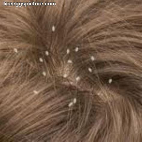 Head Lice (or Nits) Rid hair and scalp of these biting insects with ...