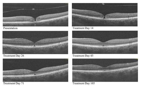 Macular Hole Closure with Medical Treatment | University Retina