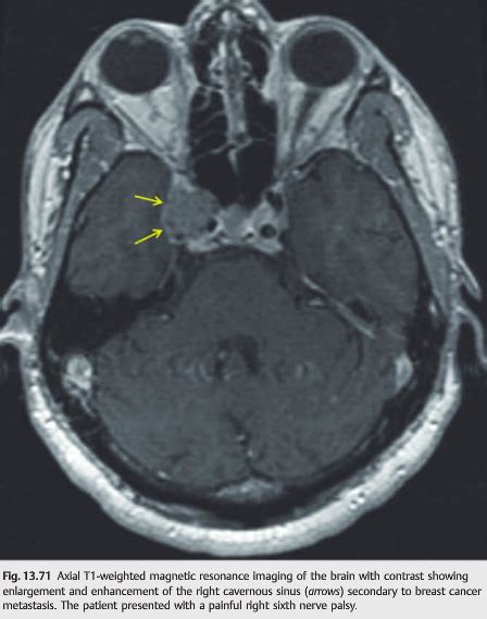 Neuro-ophthalmology Illustrated Chapter 13 – 4 – 6th Nerve Palsy ...