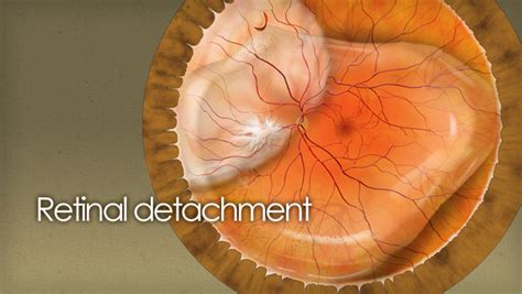 Retinal detachment causes, treatments, news and surgery