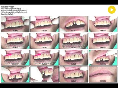 Maxillary central incisor implant setting/ 상악전치 발치후 즉시 식립 보철 완성 - YouTube