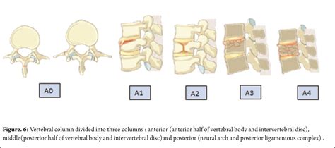 Posterior Neural Arch Fracture