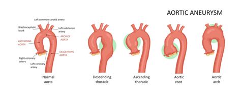 What is Aortic Root Dilatation? - Showit Blog