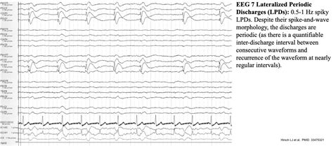 Normal Versus Abnormal Eeg