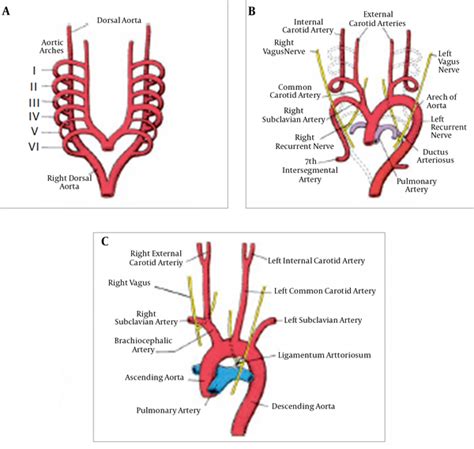 Right Sided Aortic Arch with Type C Aortic Arch Interruption: CT ...