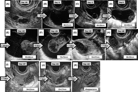 The chronological change in transvaginal ultrasound images of a ...