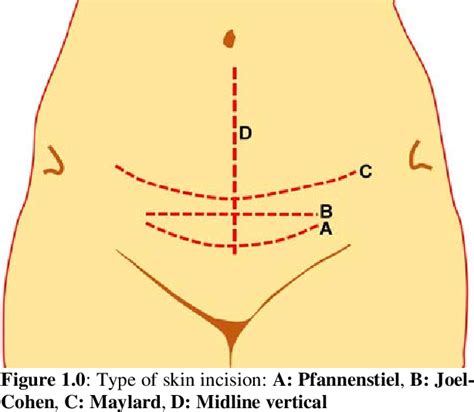 Figure 1 from Lower Segment Caesarean Section: Evidence-Based Practice ...