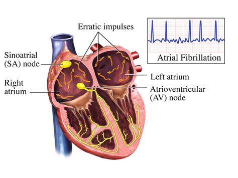 Atrial Fibrillation | NHLBI, NIH