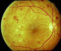 Diabetic Retinopathy - Lang Eye Clinic