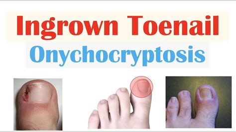 Ingrown Toenail (Onychocryptosis) | Causes, Risk Factors, Signs ...