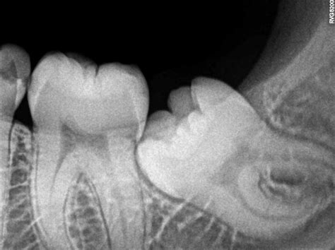 Wisdom Teeth Pain | Wisdom Tooth Symptoms | Impacted Molars & Extraction