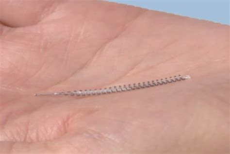 Essure Sterilisation Implant: Growing Health Concerns Over The ...