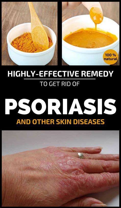 Highly-Effective Remedy To Get Rid Of Psoriasis And Other Skin Diseases ...