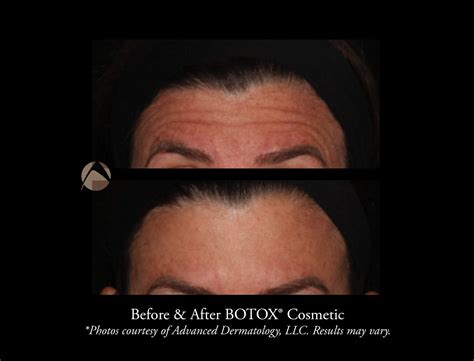 Before & After Photos | Advanced Dermatology