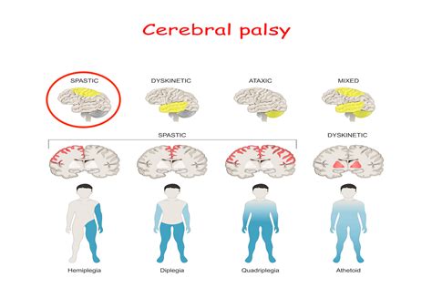 Spastic Cerebral Palsy | LegalFinders