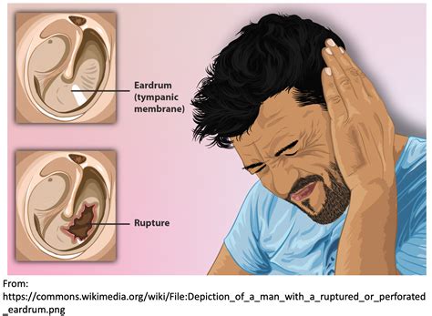 emDOCs.net – Emergency Medicine EducationEM@3AM: Tympanic Membrane ...