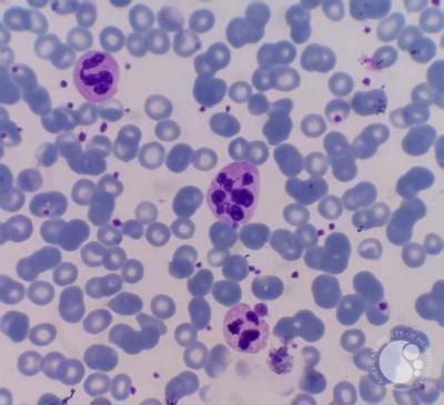 Nuclear hypersegmentation of neutrophils, eosinophils, and basophils ...