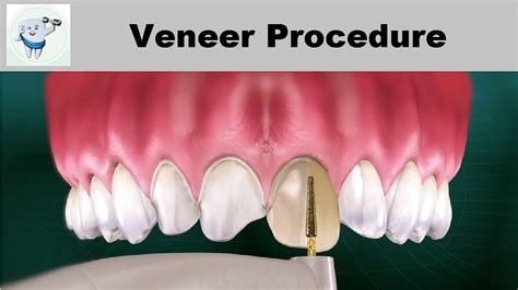 Dental Veneers Procedure Step by step - YouTube