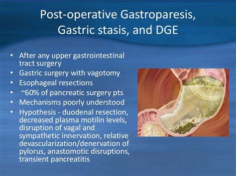 Accupuncture gastroparesis 11-3