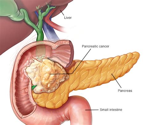 Gastroenterologists In Florida | Pancreatic Cancer (adenocarcinoma ...