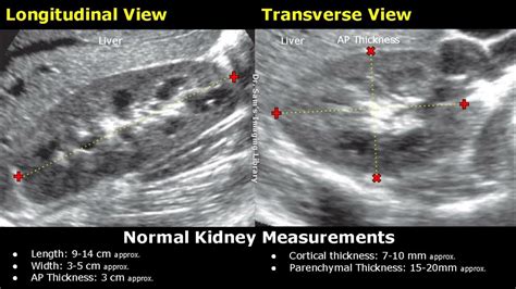 How To Measure Kidney On Ultrasound | Renal Length, Width, AP Thickness ...