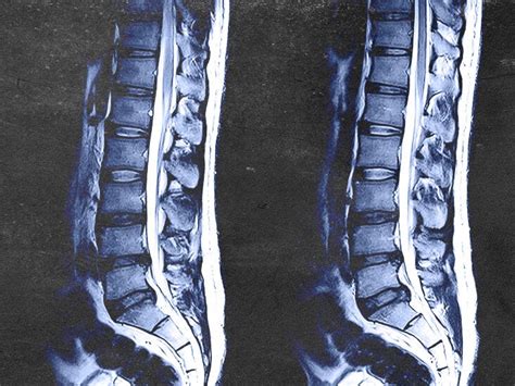 Mri Lower Back Pain