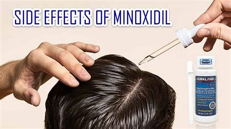 What About Side Effects Of Minoxidil? Read This First!