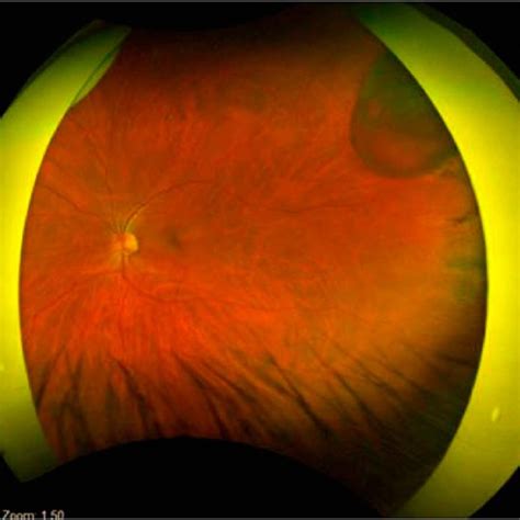 (PDF) Case Report on Giant Pars Plana Cysts Mimicking Retinal Detachment