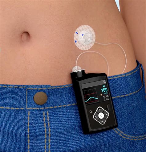 Insulin Pump Brands