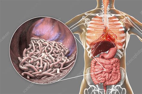 Round worms in human intestine, illustration - Stock Image - F032/6006 ...