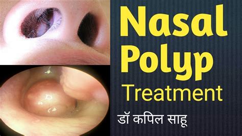 Nasal Polyps Anatomy