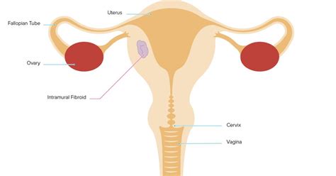 Intramural Leiomyoma of the Uterus: Understanding Symptoms, Diagnosis ...