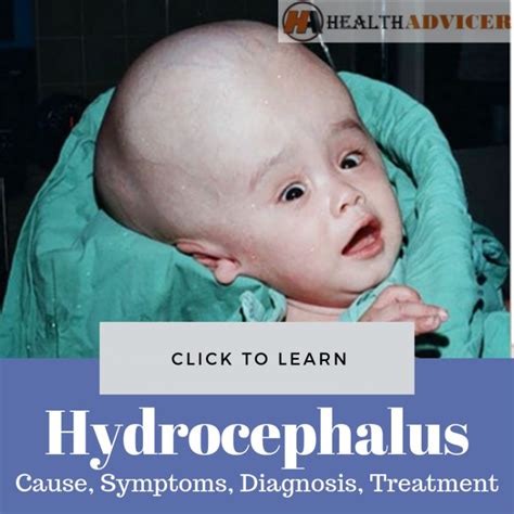 Hydrocephalus: Causes, Picture, Symptoms And Treatment