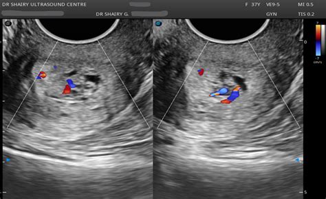 Cervical Polyp Ultrasounds Scan in Gurgaon-Dr Shairy Ultrasound Centre