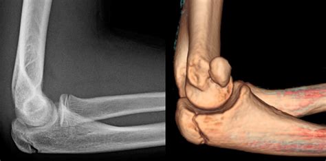 Medial Epicondyle Fracture